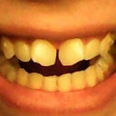 Open mouth. Here you can kinda see my bottom teeth are worn down and my front teeth have chips.