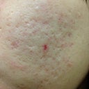 Before DermaPen Treatment - A lot of acne scars.