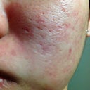 1 day after DermaPen Treatment
