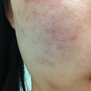 1 week later (Right)