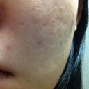 1 week later (Left)