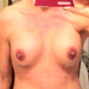 Notice that right breast seems smaller and nipple facing a bit outward and also higher than left...