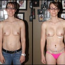 Front view time lapse - pre-surgery to day 10