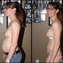 Left view time lapse - pre-surgery to day 10