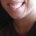Pre-op, one of the rare photos where you can actually see how gummy the smile was.