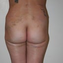 mommy makeover post op 6/23/10 flanks