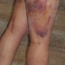 mommy makeover post op flanks