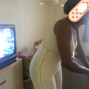 3 days PO..just fitted for compression garment.