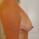 Side View - Before
