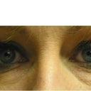 lower eyelids before