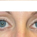lower eyelids after