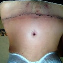 Incision   Still scabs