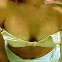 3rd Day Post-Opt. Cleavage line starting to appear! Still swollen between and "squishy" feeling but getting better.