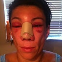 Me when I got up this morning, wow was my right eye swollen