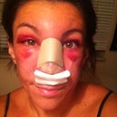 By the end of the 2nd day post op, this is what i looked like