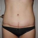 PO 6 months.  The scar is unchanged but I'm getting a revision anyways in 6 months.