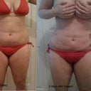 front, 2 days post surgery.