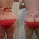 back, 2 days post surgery.  No more bra rolls!