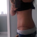 PO15 - Side Scar