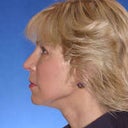 Dr photo after face lift, fat transfer, dermabrasion and brow lift - unretouched