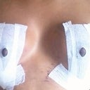 Day 9 Post Op (Nine days after surgery)... Front view. Still swollen, but tension in center cleavage area and sides starting to relax...