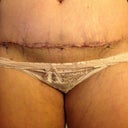incision- 1 week post-op. still purple from marker. See that stitch directly below my bb on the pubic area? That is where my OLD bb was. THAT is how much skin/fat he pull down!