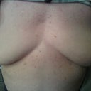 this is day four after explant  left side was the side that deflated and looks a little better than the right