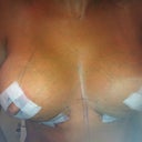 3 days after surgery