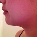 3 months post-op.