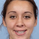 Orthognathic Jaw Surgery