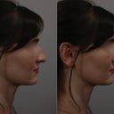Before and after computer version