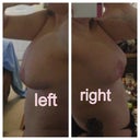Post op week 8