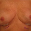 1st day  post-op immidiately after bra removed.  They looked a bit saggier after a 10 min. shower with no bra.