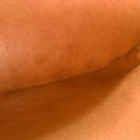 Under boobs looks good. May not need scar treatment, we'll see.