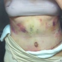 Day 9 PO. I am so bruised, but you can see how much tightening was done.