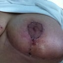 Left post op 13 days