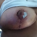 Right post op 13 days