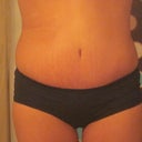 4 weeks post op