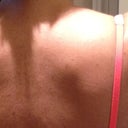1 day after. My arms are 1/2" smaller around (1" when measured in compression garment). The back of my arm is very tender so hopefully there is a little more swelling yet to subside.