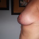 11 Weeks Post Op Side Profile Left