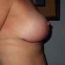 11 Weeks Post Op Side Profile Right