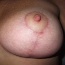 Close up of scar healing 11 weeks post op