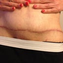 Scar 6 months post op