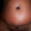 1wk after tummy tuck photo #1