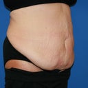 tummy right side