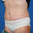 left post op tummy