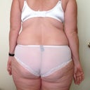 One week before surgery