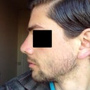 2 months postop