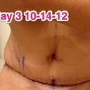 I think my incision is pretty darn straight