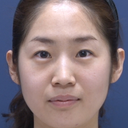 30 Year Old Lady Who Has Undergone Forehead & Eyebrow Lift